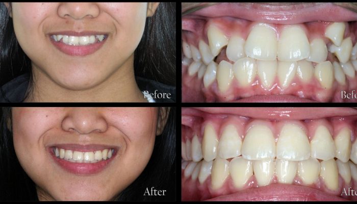 Orthodontic-Patient-93-Before-and-After