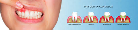 Painless Laser Gum Surgery in Gandhinagar