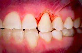 Gum Disease Treatment in Gandhinagar