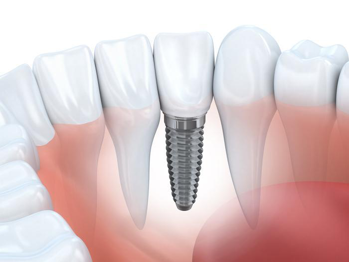 Best Dental Implant in Gandhinagar