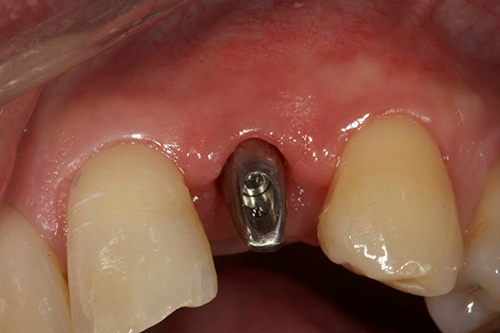 Dental Implant Clinic Gandhinagar