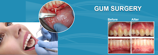 Best Painless Laser Gum Surgery in Gandhinagar