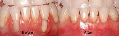 Best Gum Disease Treatment in Gandhinagar