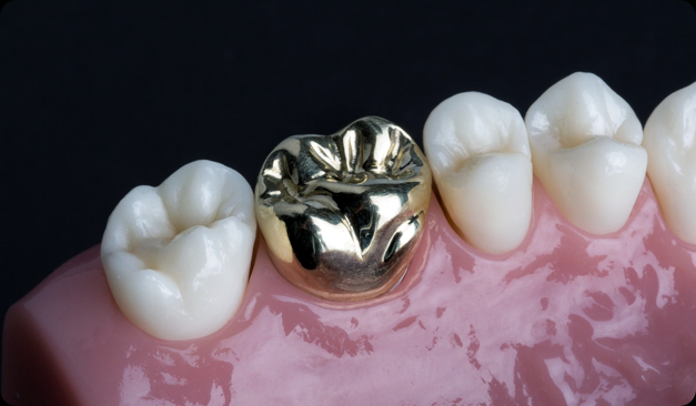 Dental Crowns Treatment in Gandhinagar
