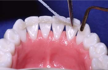Best Teeth Splinting clinic in Gandhinagar