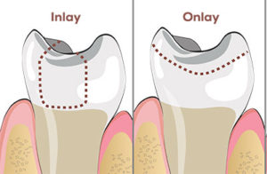 Dental Onlays in Gandhinagar