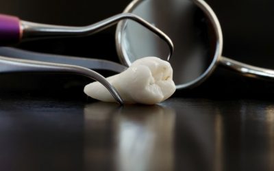 Best Wisdom Tooth Removal Cost in Gandhinagar