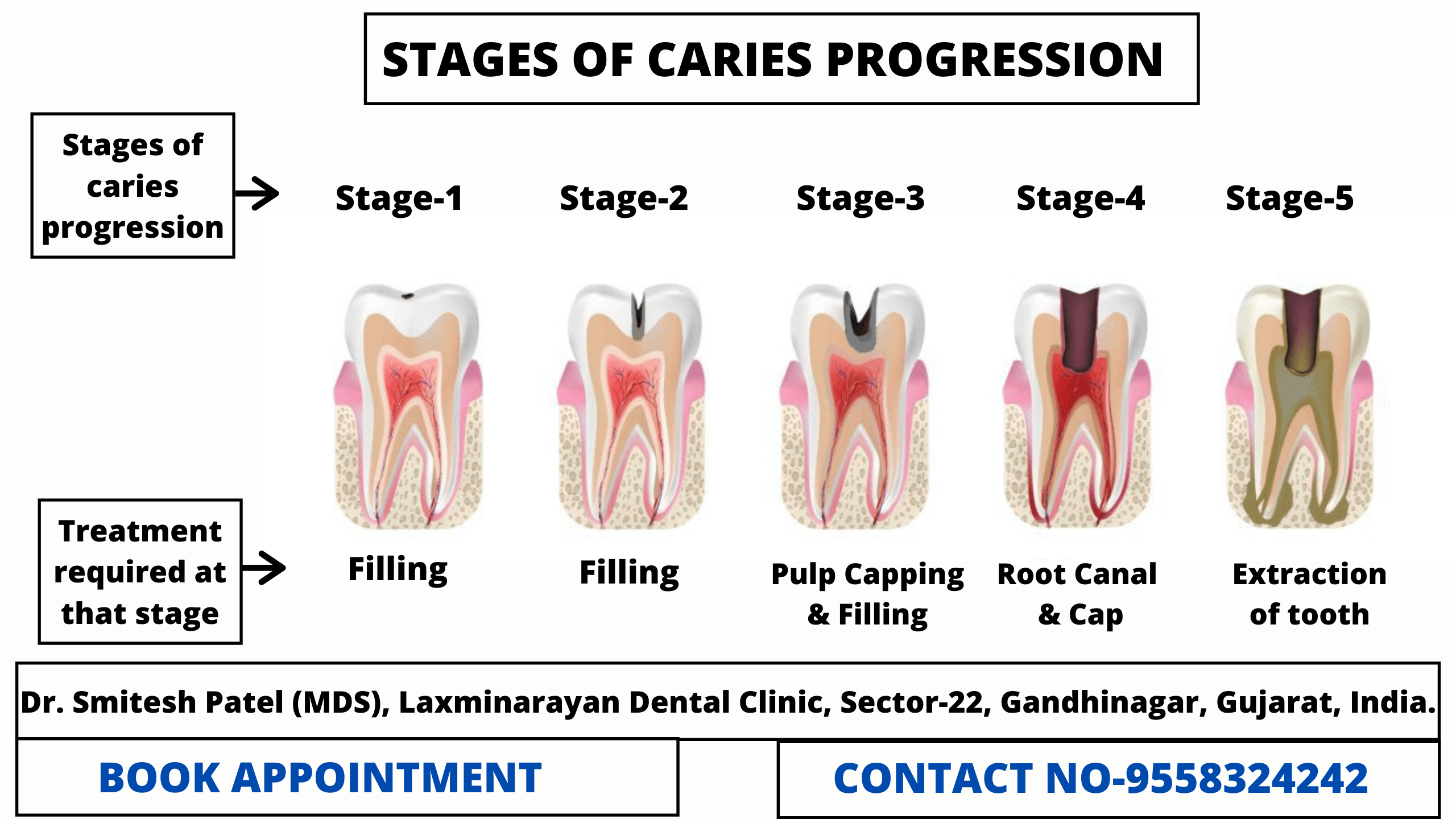 dental caries progression