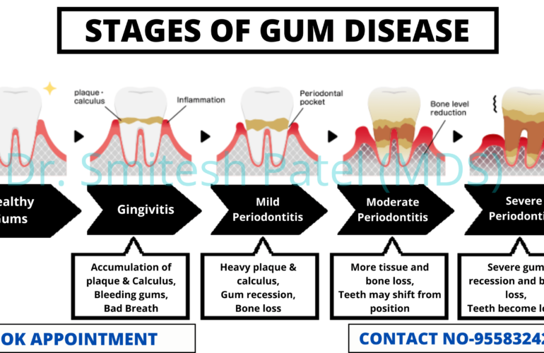 Root Canal Specialist in gandhinagar