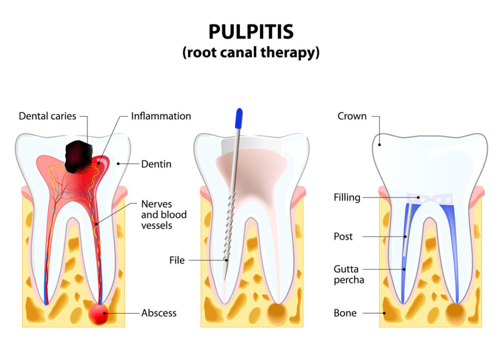 Root Canal Cost in India