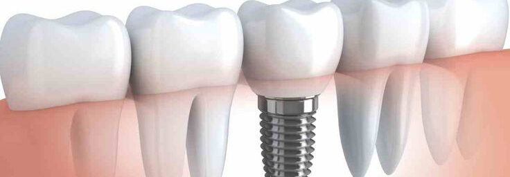 Cost of dental implants in Gandhinagar, Gujarat