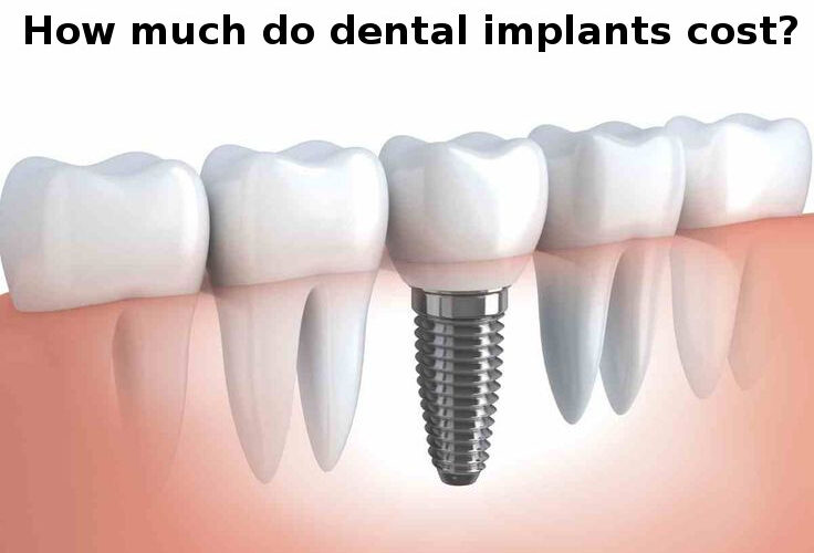 Cost of dental implants in Gandhinagar, Gujarat