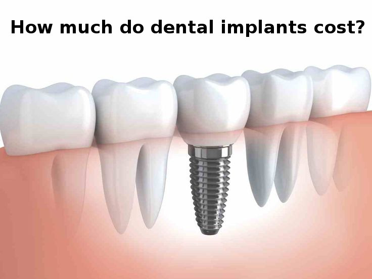 Cost of dental implants in Gandhinagar, Gujarat
