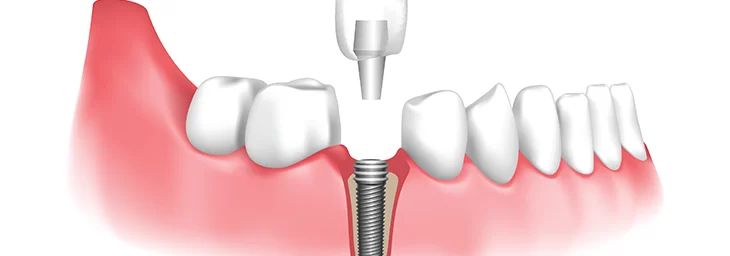 an image of dental implants for teeth replacement