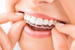 Clear aligners will make your smile brighter without using metals