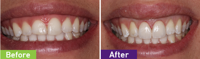 Cosmetic Dental Treatments Gandhinagar