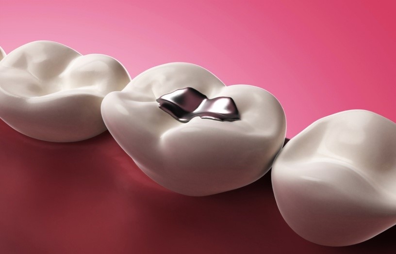Cavity Treatment in Gandhinagar