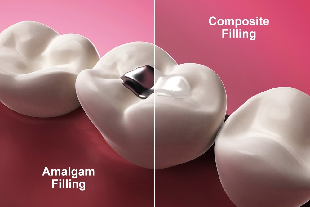 Cavity treatment cost in Gandhinagar