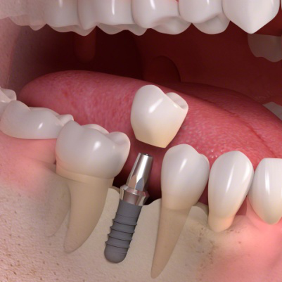 Dental Implant in Sargasan