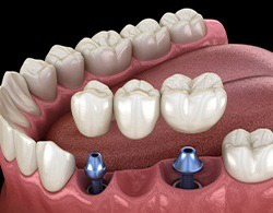 Dental Implant Kudasan