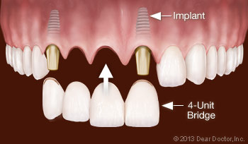 Dental Implant in Raysan