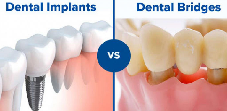 Top Dental Implant in Gandhinagar