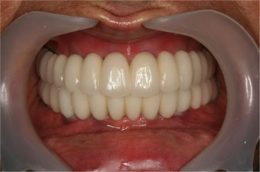Trusted Dental Implant in Gandhinagar