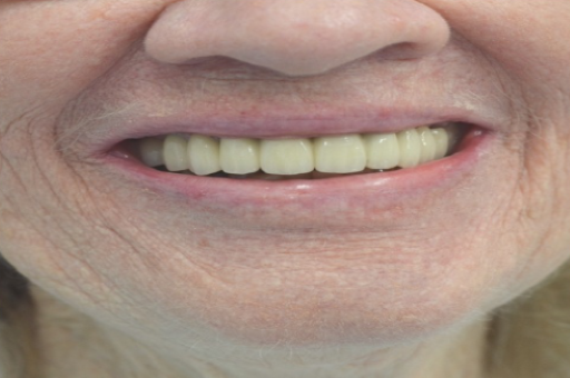 Good Dental Implant in Gandhinagar
