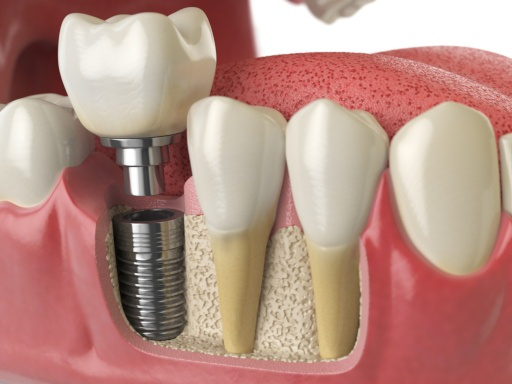 Dental Implant Gandhinagar