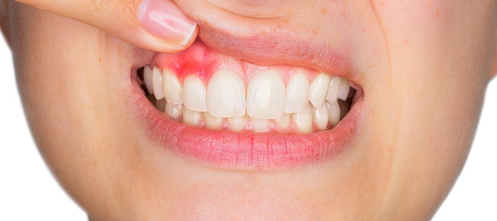 Gum Disease Treatment in Gandhinagar
