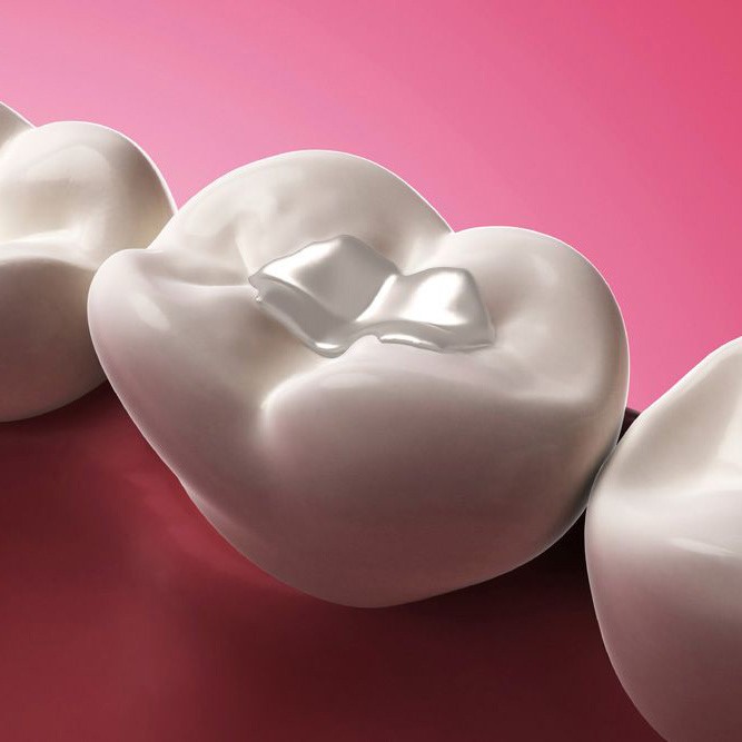 Best Cavity Treatment in Gandhinagar