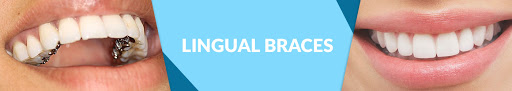 Aligners Treatment In Gandhinagar