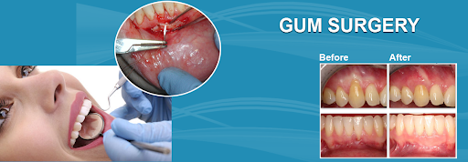 Best Painless Laser Gum Surgery Gandhinagar