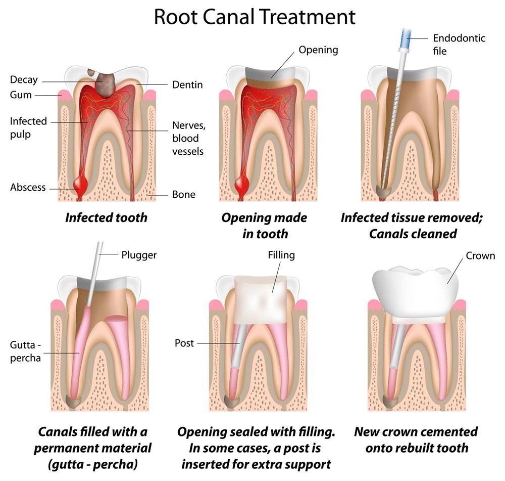 Painless Root Canal Doctor in Gandhinagar