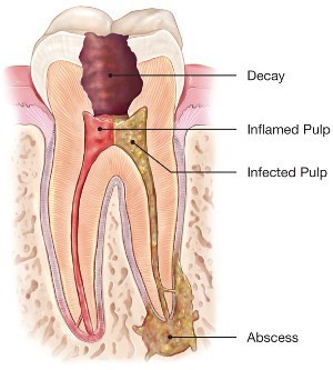 Root canal specialist in Gandhinagar