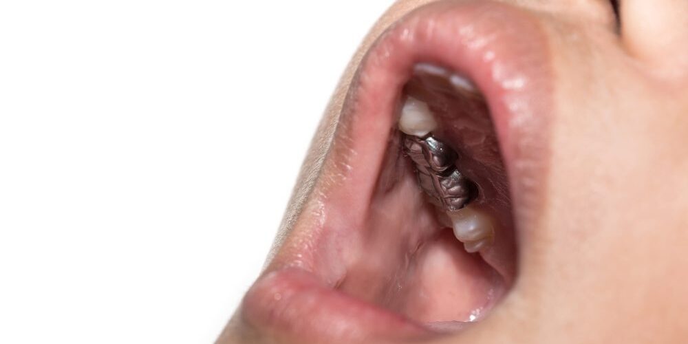 For Pediatric Patient Post-treatment Instructions After Stainless Steel Crown/cap