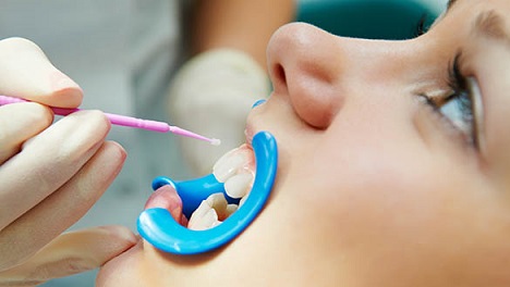 Do not drink or eat for at least 60 minutes. Do not brush the teeth for 24 hours. Come for Fluoride application every 6 months. One should complete remaining dental treatment advised by your dentist without failure to keep your teeth and gums healthy. Annual dental check-up is must and if treatment is needed, it should be completed as per the doctor’s advice because prevention is better than cure.