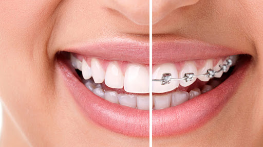 Instructions To Be Followed By Patient After Orthodontic Treatment