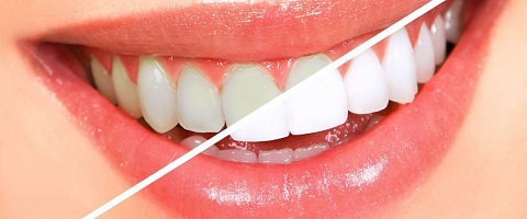 Instructions To Be Followed By Patient After Teeth Cleaning And Polishing