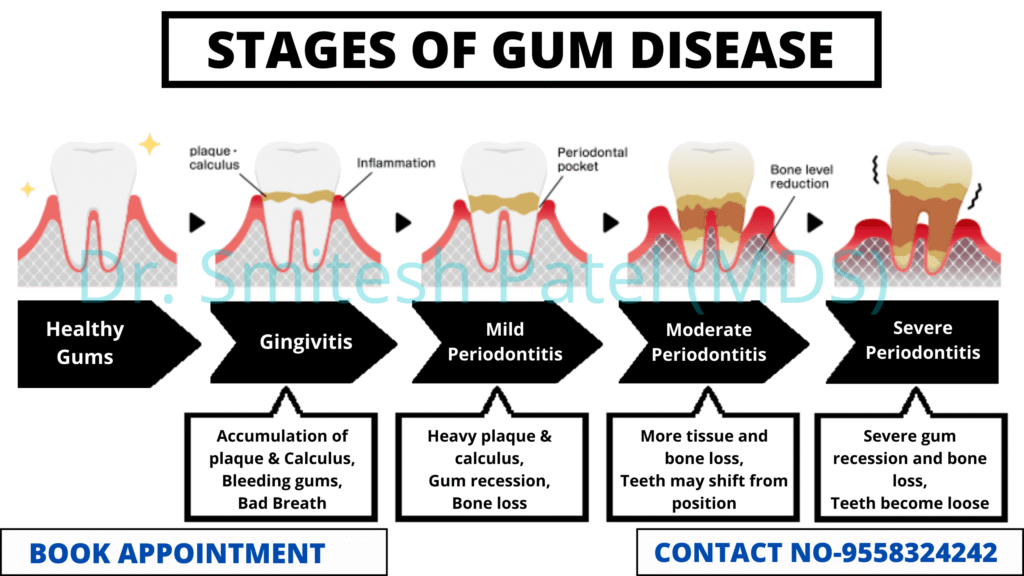 Why you should care for your gums