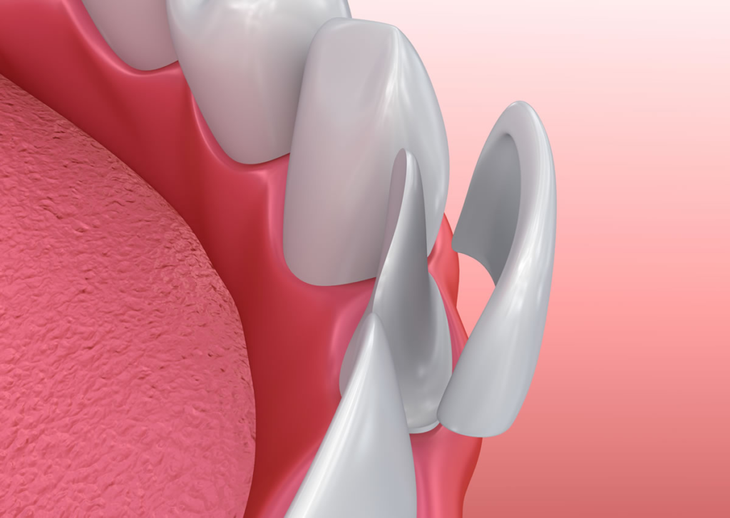 Porcelain Veneers In Gandhinagar