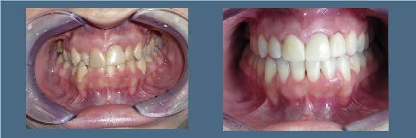 Smile Makeover in Gandhinagar