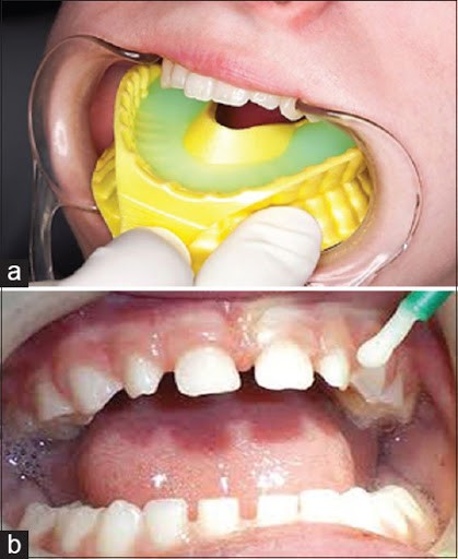 Fluoride Treatment Gandhinagar