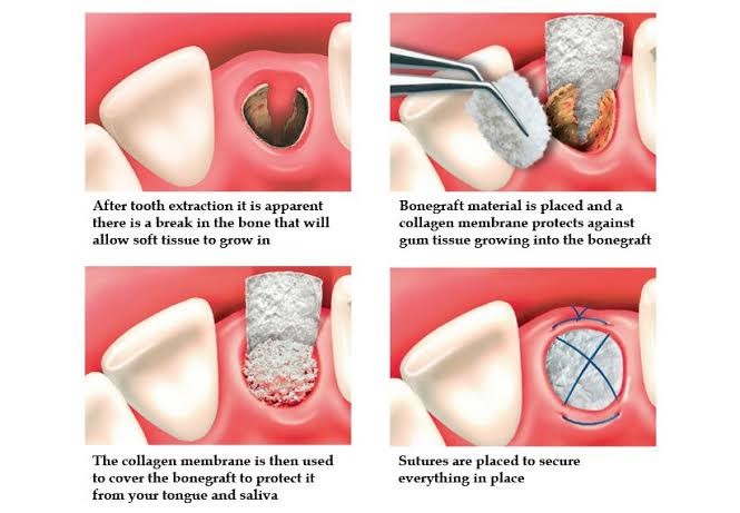 Flap Surgery in Gandhinagar