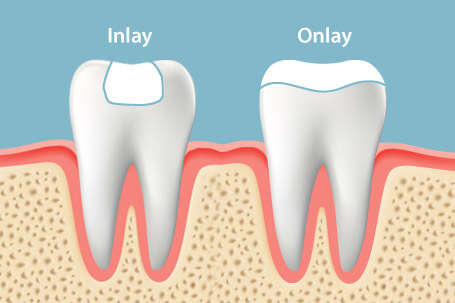 Dental Onlays in Gandhinagar