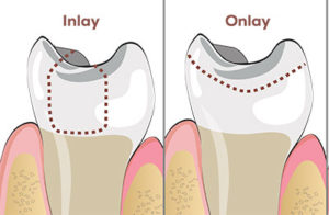 Dental Inlay Cost in Gandhinagar