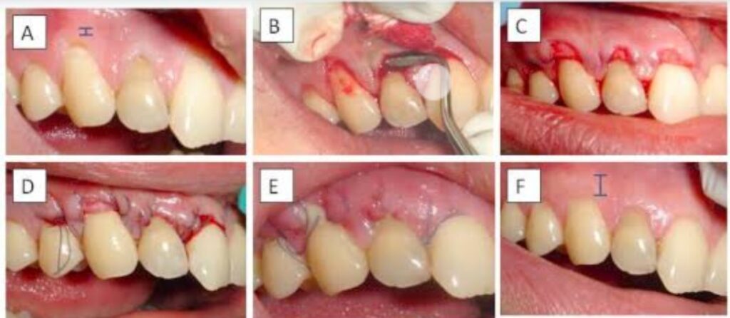Bone Grafting Dental Treatment Gandhinagar
