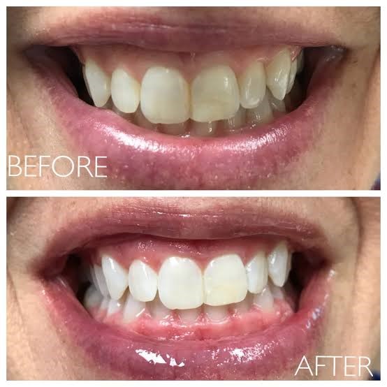 Teeth cleaning dental clinic Gandhinagar